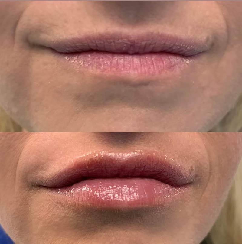 dental patient with Lipslase